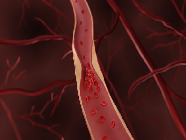 Atherosclerosis, Narrowed artery