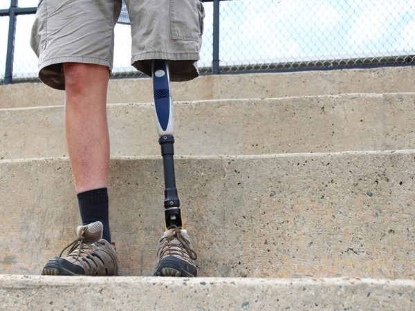 Standing man with prosthetic leg